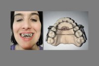 A photo of a woman with mangled teeth smiling next to an image of an AGGA device.