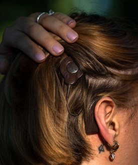A photo of the back of Mai's heading, showing her hearing device implant.