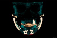 A scan of a person's skull with jaw impants highlighted.